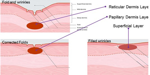 Best price Fractional Rf Wrinkle Removal Face Lift, Skin Rejuvenation, Wrinkle Remover, ScMicroneedle quipment for sale