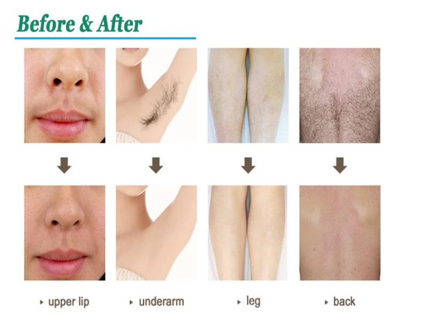 Safe And Effective Hair Removal With 808nm Diode Laser Machine For Smooth Skin 755nm/808nm/1064nm