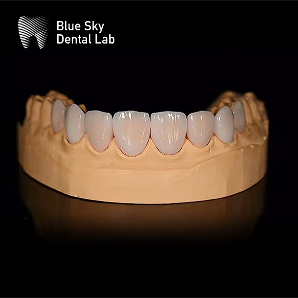 Ultra Thin Sleek Veneer Cases 0.3mm Thinnest Custom Veneers
