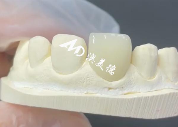 Durable and Aesthetic EMAX Veneer The Perfect Solution for Porcelain Restoration