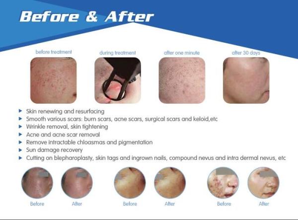 Buy cheap most advanced 30w power USA Coherent laser vertical fractional co2 laser with vaginal tightening from wholesalers