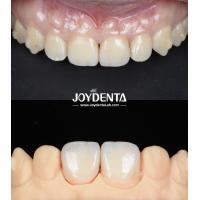 Buy cheap Lightweight Smooth Surface Zirconia Dental Bridges For Implant Supported product