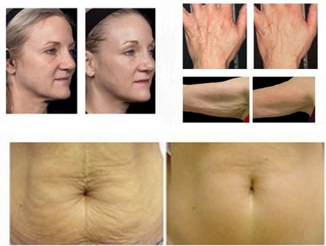Hot sellingt face lift Thermage machine fractional rf microneedle therapy system