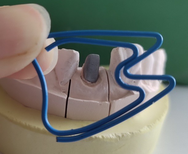 Metal Dental Post And Core After Endodontic Treatment
