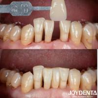 Buy cheap Natural Shape Ceramic Maryland Bonded Bridge Dental Restorations Excellent product