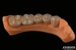 Precision Dental Restorations Full Zirconia High Flexural Strength Natural Color