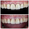 Buy cheap Comfortable Zirconia Dental Bridges Lightweight Natural Color Transitions For Optimal Patient Experience from wholesalers