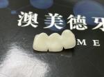 Natural Aesthetics Translucent Ceramic Crowns for Dental Restoration with Easy