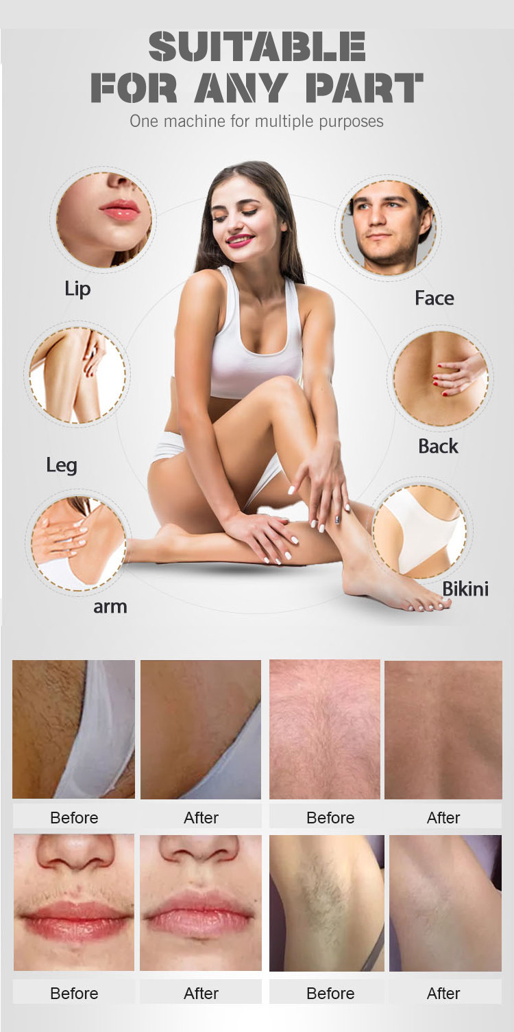 Frequency 0.5-10Hz Diode Laser Hair Removal Machine with Tailored Display