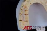 Seamless Porcelain Emax Veneers Teeth Replacement Authentic Looking