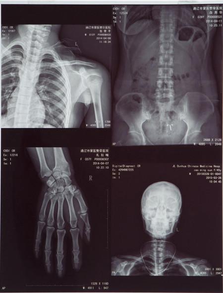 Buy cheap 11X14 Inch Medical X-ray Film/Analogue Medical Film/Dry Film from wholesalers
