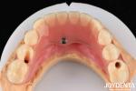 1 Piece Ti-Base Acrylic Teeth Finish Translucent Color Dental Acrylic Resins