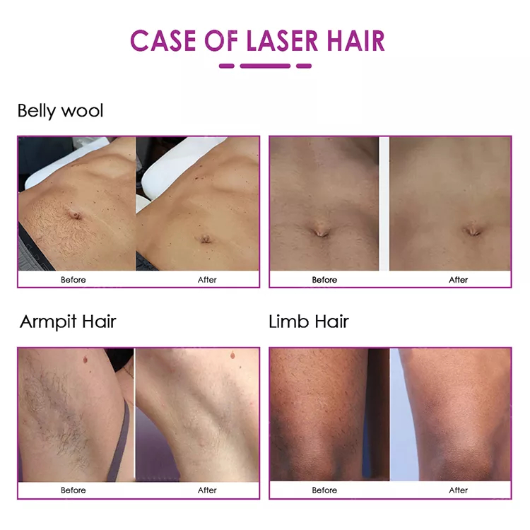 DPL most intelligent and professional portable permanent Hair Removal 808nm laser diode beauty equipment