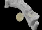 Accurate Fit Dental Ceramic Inlays Onlays , Porcelain Inlays And Onlays FDA