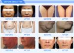 High Intensity Focused Ultrasound HIFU 3D Machine 1-11 Lines Skin Tightening