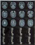 Laser Film for Medical X-ray Image Output Printing