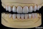 Ceramic For Natural Aesthetics Dental Veneers Stain Resistance Maintains