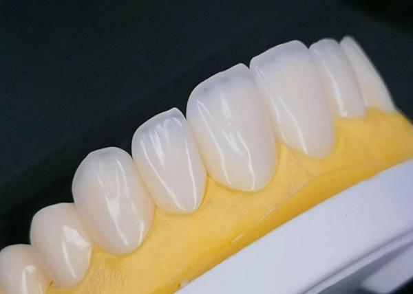Buy cheap EMAX Porcelain Veneer with Stain Resistance for Natural looking Esthetic Restorations from wholesalers