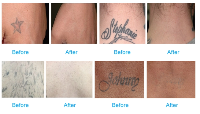Lazer Picosecond Laser Q Switched nd yag Removal Pico Laser Tattoo Removal Machine