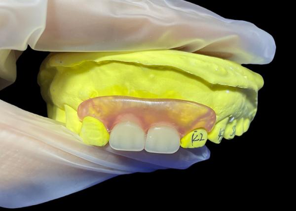Tailored Secure Fit invisible Flexible Parital Denture Replacement For