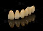 Strong Aesthetic Porcelain Fused To Zirconia For Natural Looking Restorations