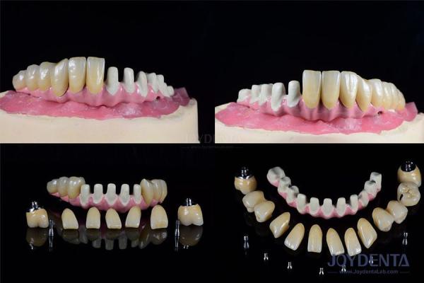 Buy cheap Multiple Endosseous Dental Implants Internal Connection For Full Arch Restoration from wholesalers