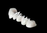 Full Arch Zriconia Dental Crown With Astonishing Natural Appearance