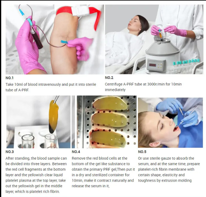 Plastic Tube 10ml 13ML Platelet Rich Fibrin PRF Tube With No Additive Recommended Storage Temperature 4-25C