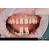 Buy cheap Long Lasting Dental Composite Veneer Good Biocompatibility No Drop Off porcelain veneers from wholesalers