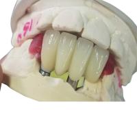 Buy cheap Strong Ti Base Milling Dental Implant Crowns Tooth Supported Bridge product