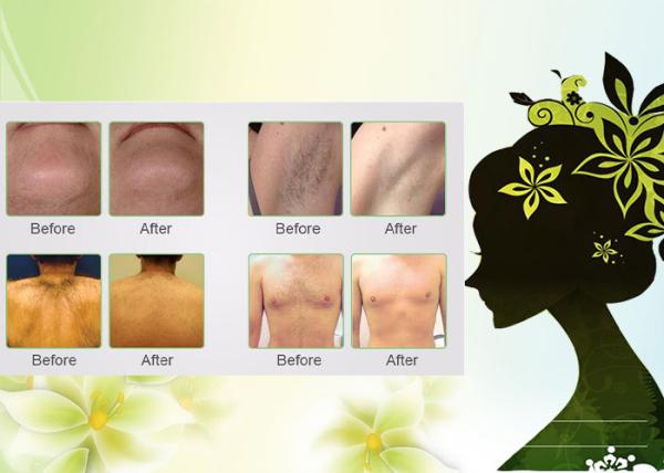 Buy cheap Laser diode 808 hair removal machine with permanent results from wholesalers