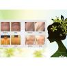 Buy cheap Laser diode 808 hair removal machine with permanent results from wholesalers
