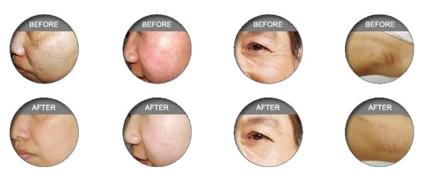 Pain free equipment for beauty salon SHR IPL hair removal machine