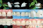 Ceramic For Natural Aesthetics Dental Veneers Stain Resistance Maintains