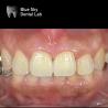 Buy cheap Hypoallergenic Dental Implant Zirconia Abutment Biocompatible from wholesalers