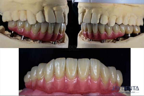 Buy cheap Dental Reconstruction Multiple Teeth Implant Titanium Prosthetic Connection Internal from wholesalers