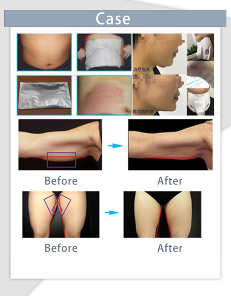 LF-218 portable cryo slimming machine / cryo for fat reduction / cryo slimming device