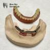 Buy cheap Implant Overdenture Titanium Bar Dental Implant with removable denture from wholesalers
