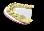 High-Quality Ceramic Inlays and Onlays for Seamless and Long-Lasting Tooth