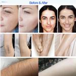 Q Switch 2 Handles Soprano Diode Laser 808nm Nd Yag For Hair Removal
