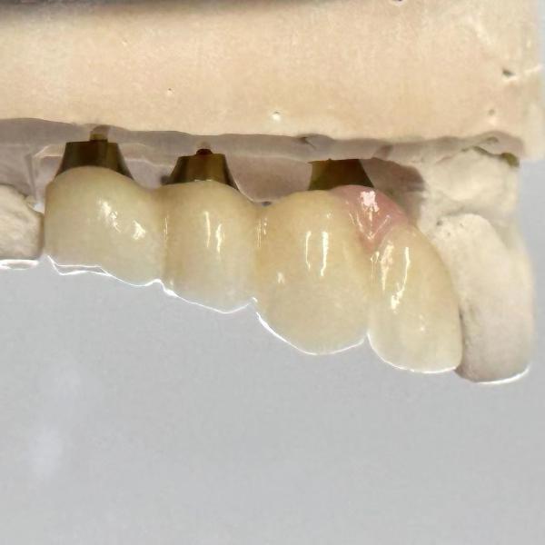 Porcelain Zirconia Cement Retained Screw Implant Hexagonal Head Shape for Custom