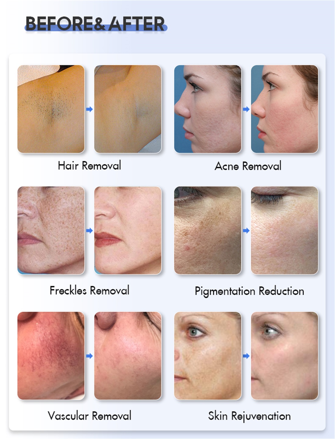 IPL OPT E-light Dpl Skin Rejuvenation Pigment Freckle Laser Hair Removal Machine