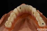 Low Density Titanium Malong Hybrid Bridge Dental Light Weight Comfortable Wear