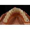Buy cheap Low Density Titanium Malong Hybrid Bridge Dental Light Weight Comfortable Wear from wholesalers