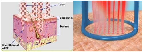 Multifunction medical laser co2 fractional/fractional co2 laser/co2 fractional laser CE/FDA approval