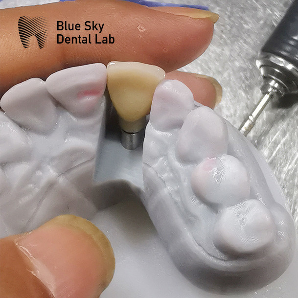 Customized Full Mouth Implant Case Universal Compatibility