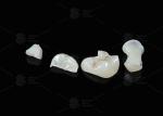 Translucent Onlay Zirconia Inlay For Long Lasting Stain And Wear Resistance