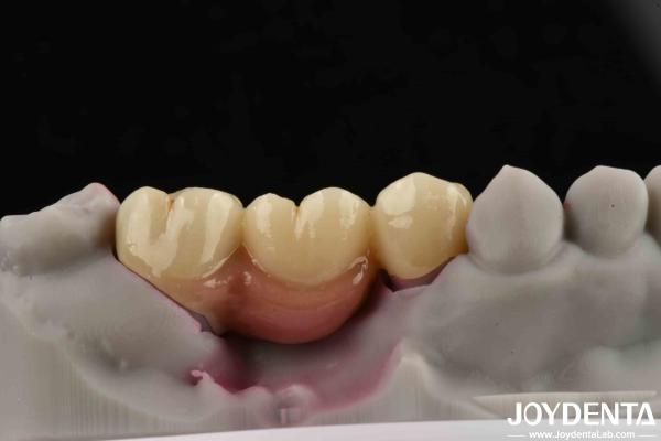 Buy cheap Customizable Dental Implant Supported Bridge And Crown For Dental Implants from wholesalers
