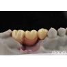 Buy cheap Customizable Dental Implant Supported Bridge And Crown For Dental Implants from wholesalers