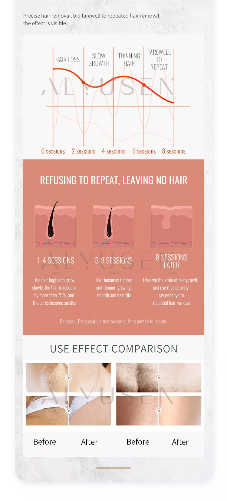 Efficient Hair Removal 808nm Laser Hair Removal Eqiument, Fast And Effective Hair Removal